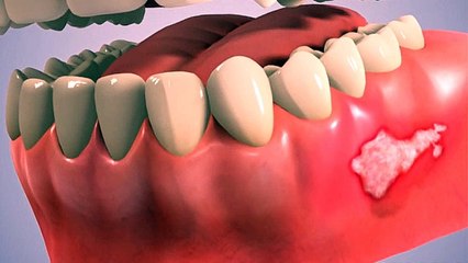 Laser Ulcer Treatment