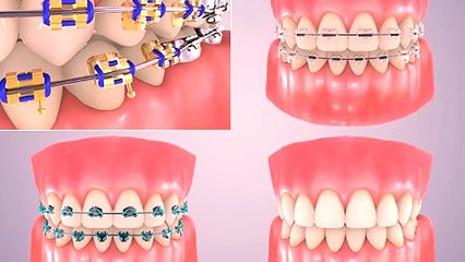 Braces Compared