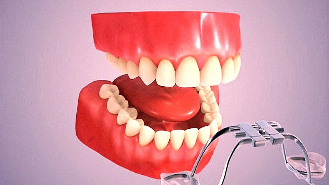 Rapid Palatal Expander