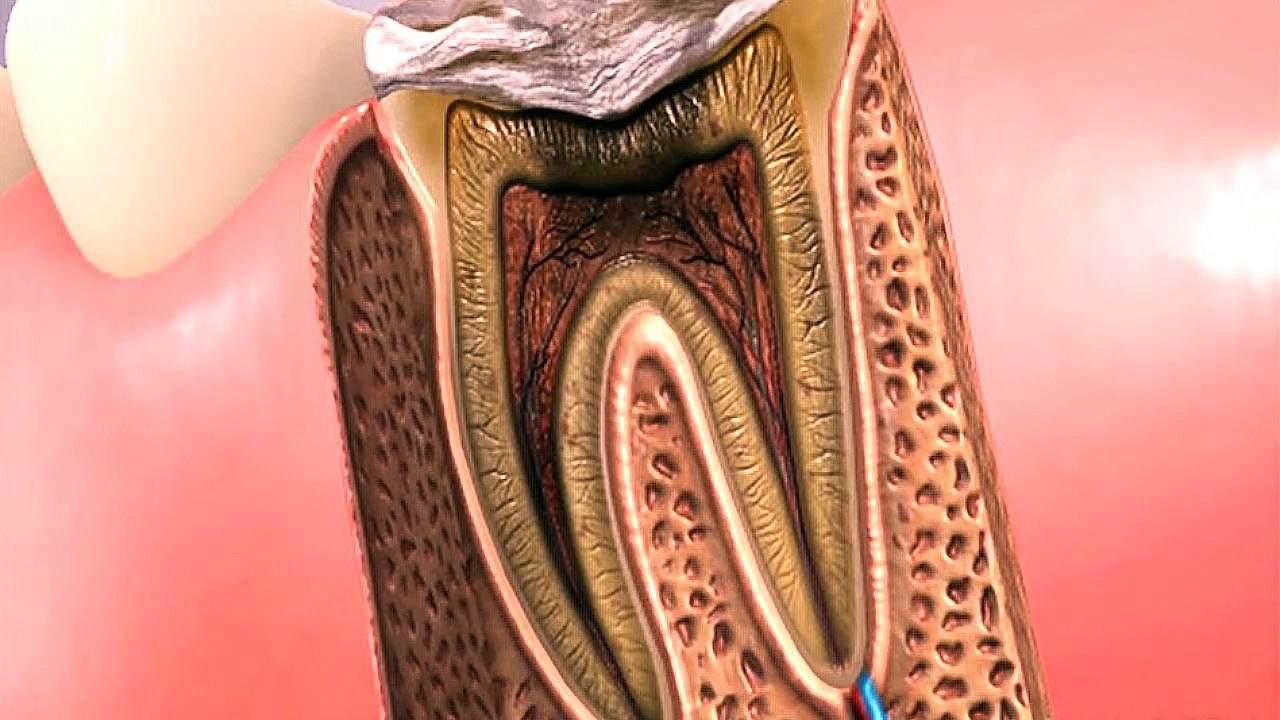 Root Canal Posterior