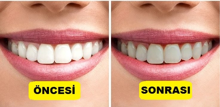 Dişlerinize Ağır Şekilde Zarar Veren Gıdalar - Hangi Alışkanlıklar Dişlerimize Zarar Veriyor