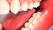 Wisdom Tooth Extraction