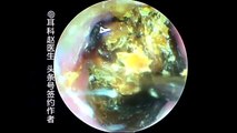 Earwax Removal, Extractions One of the biggest Earwax 可能是本年度最大一块耵聍了，外耳道挖耳屎清理 耳垢 耳垢