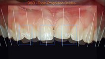 Frente restauracion dientes cerrar las brechas entre la restauración de dientes de los dientes anteriores