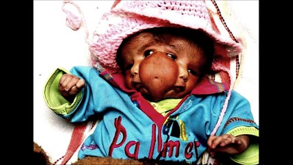 Types of Conjoined Twins