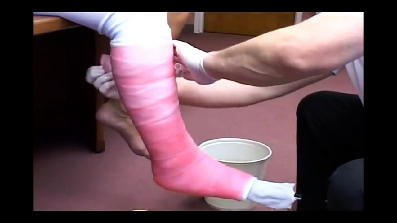 Application of a Long Leg Cast Fiberglass Medical Cast