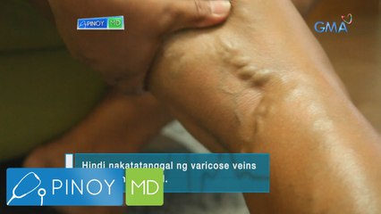 Pinoy MD: Chamomile oil, panlunas nga ba sa varicose veins?