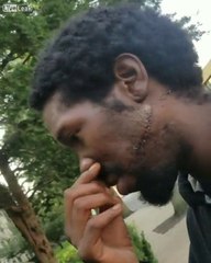 Enorme cicatrice de la joue au haut du visage !! Méchant coup de couteau..