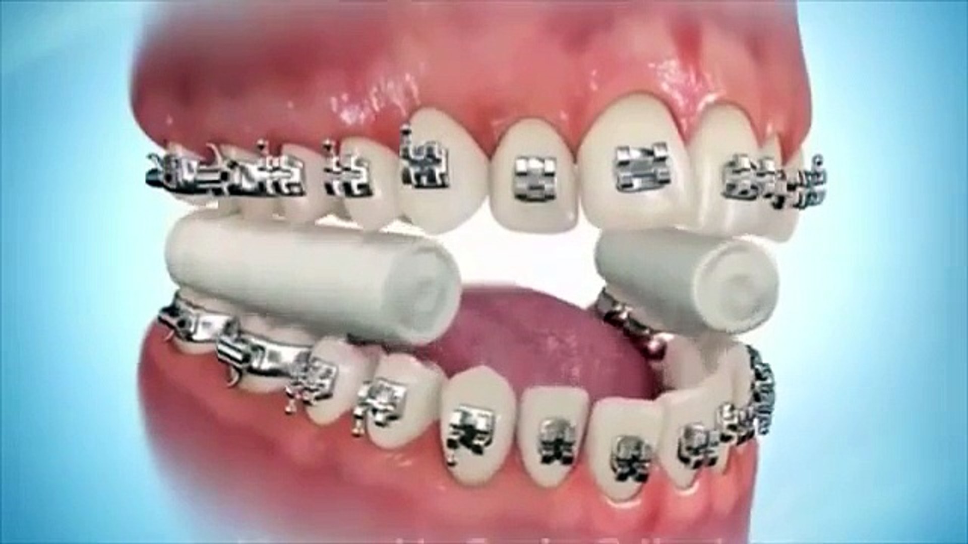How Braces Work Bangladesh Center For Orthodontics And Braces Video Dailymotion