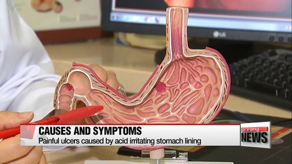 Study shows people over 40 likely to suffer stomach ulcer
