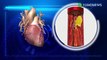 Gejala serangan jantung silent heart attack -  TomoNews