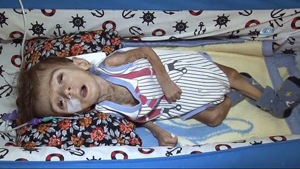 Çocukları Gözlerinin Önünde Eriyor, Onlar Kucaklarına Dahi Alamıyor