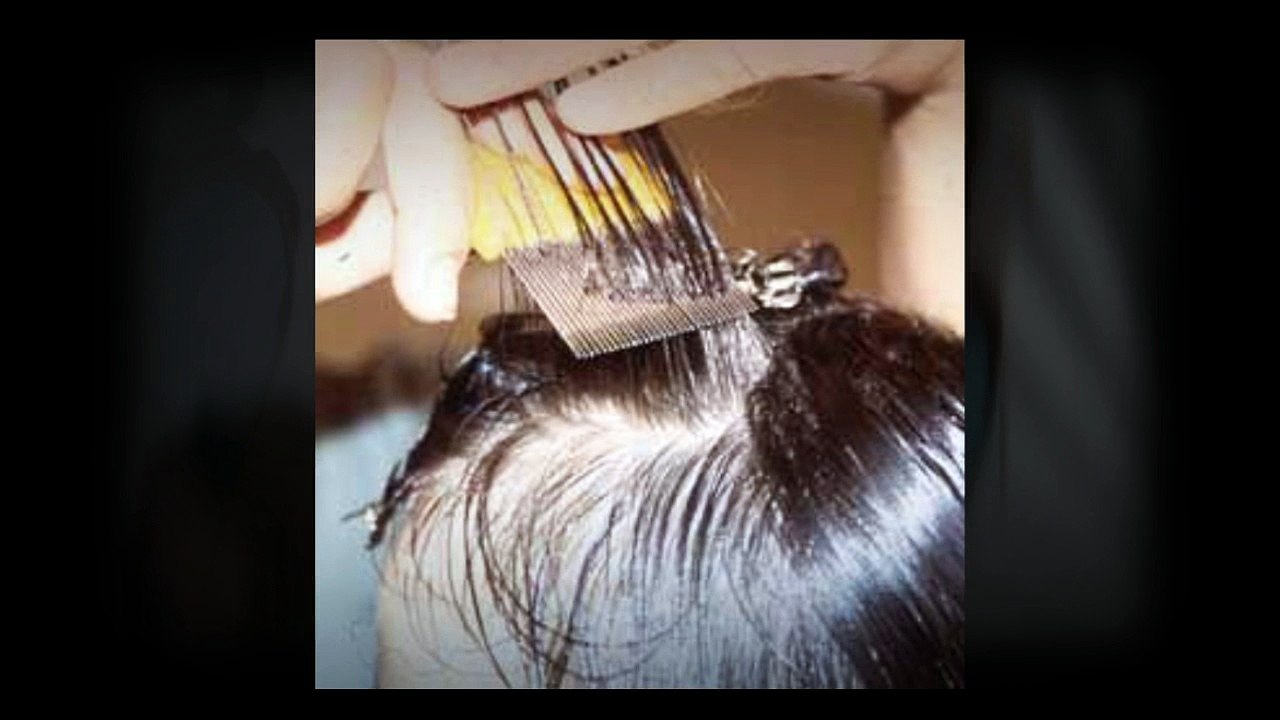 Head Lice Treatment ,   Lice Treatment Service ,   Advice on Lice Call at 240-242-4267