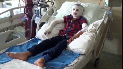 Patlayan Parfüm Şişesi Yüzünü Yaktı