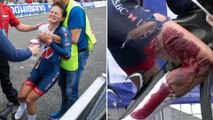 Cyclist Suffers NASTY Injury in Crash, Crosses Finish Line Anyway
