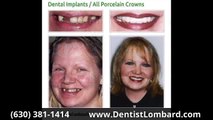 Veneers Before And After Glen Ellyn IL 630-381-1414 Glen Ellyn Before & After Dental Implants