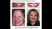 Veneers Before And After Downers Grove IL 630-381-1414 Downers Grove Before & After Dental Implants