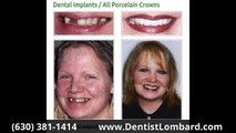 Dental Veneers Before & After Schaumburg IL 630-381-1414 Schaumburg Before & After Dental Implants