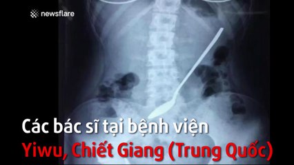 Kinh hoàng phát hiện chiếc thìa 20cm nằm trong cơ thể nữ sinh