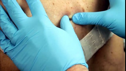 Những ca mụn đầu đen kinh khủng nhất