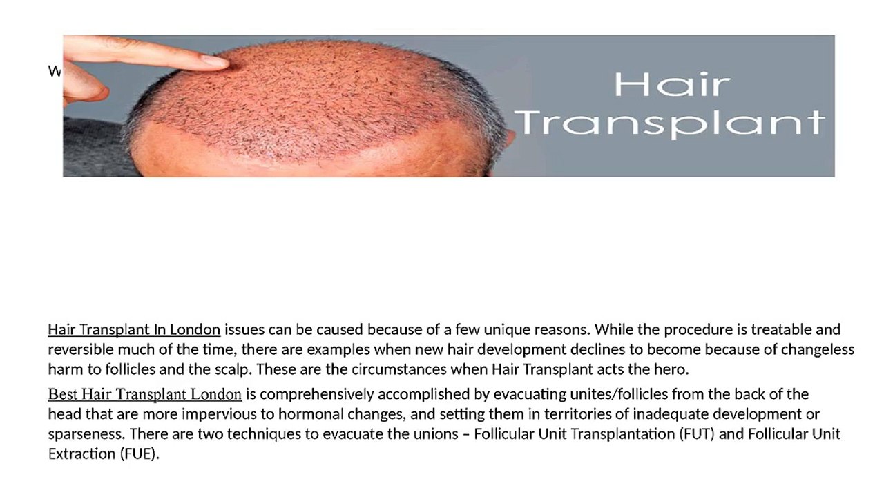 7_Things_You_Must_Know_Before_Hair_Transplant