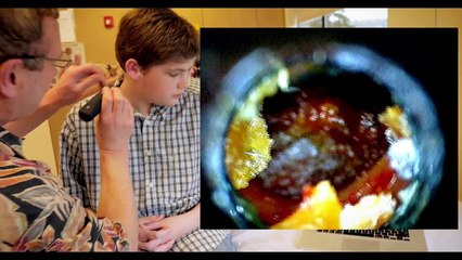 GIANT EAR WAX REMOVAL! | Dr. Paul