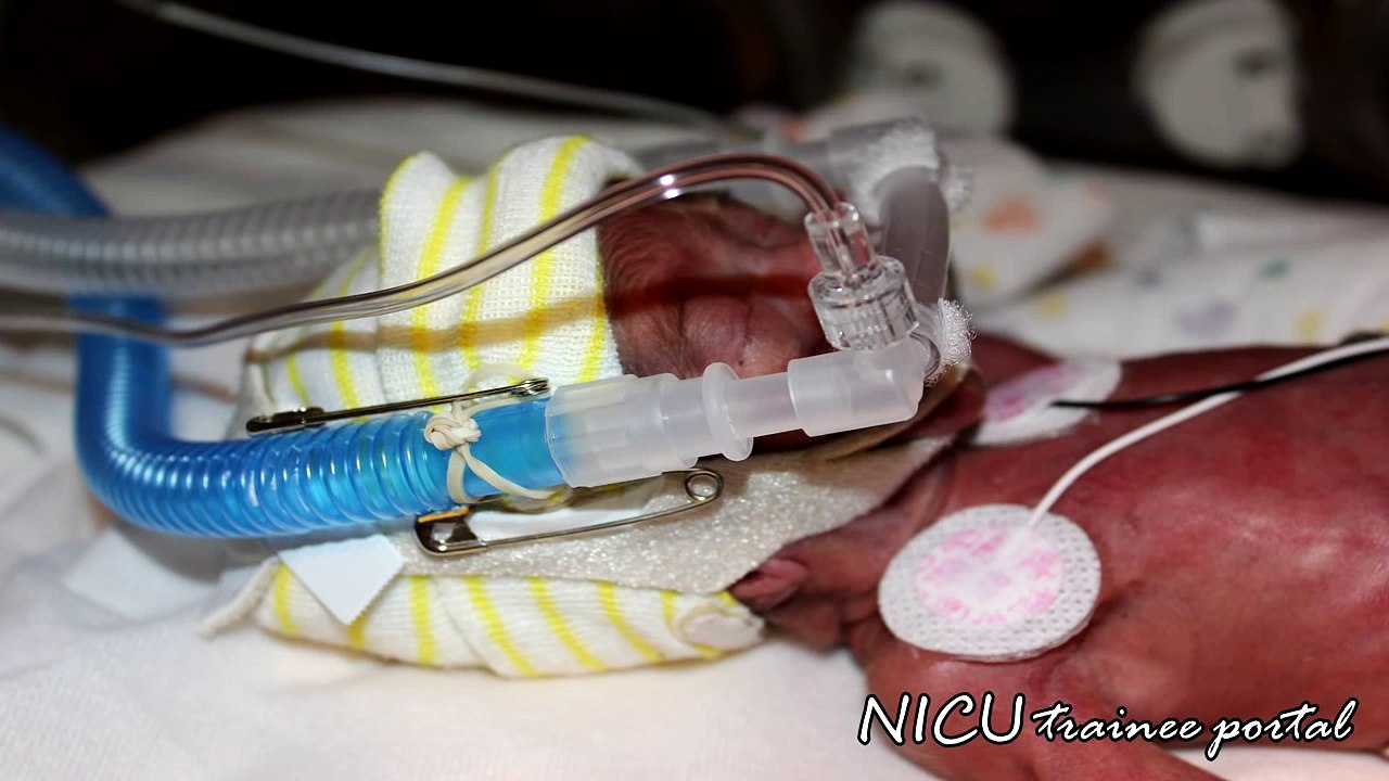 Physical Exam- 25 weeks gestation preterm infant