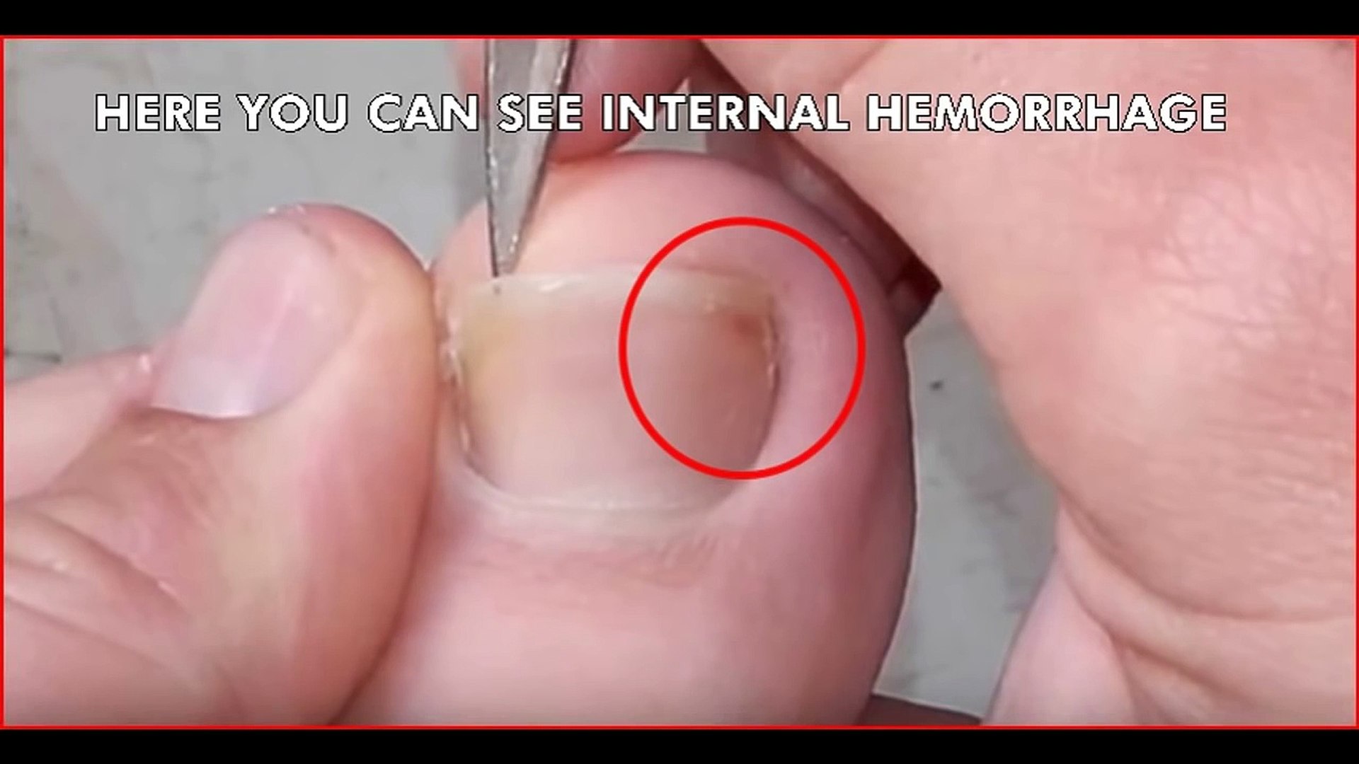 Ingrown Toenail Removal Video Dailymotion