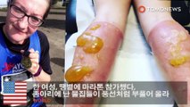 한 여성, 땡볕에 마라톤 참가했다, 종아리에 난 물집들이 풍선처럼 부풀어 올라