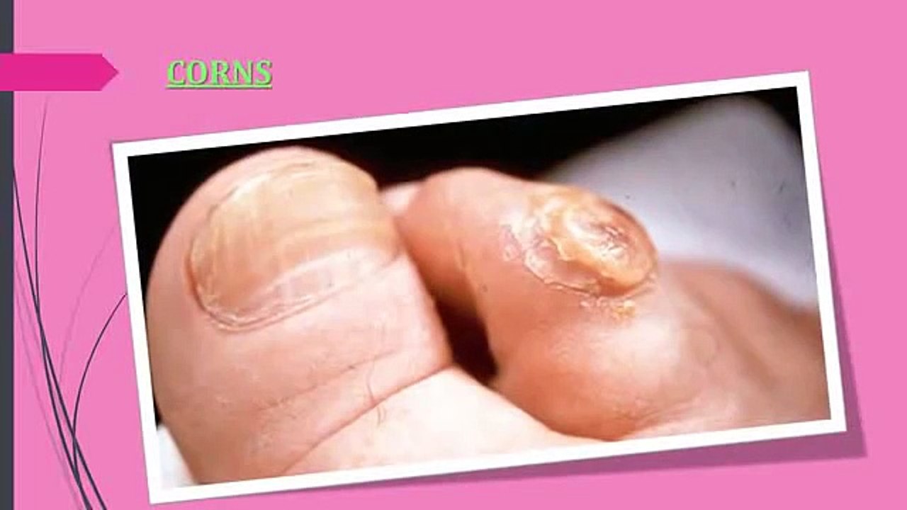 corns on feet removal home remedies