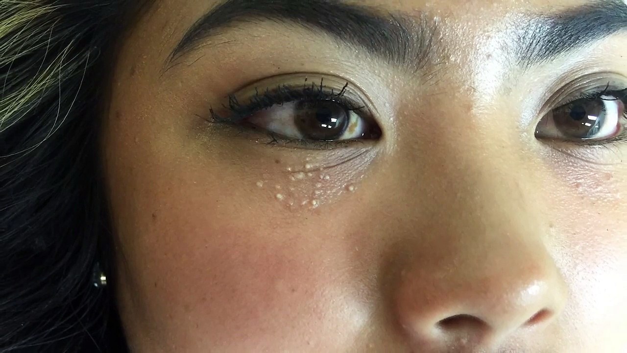 Multiple milia under the eyes