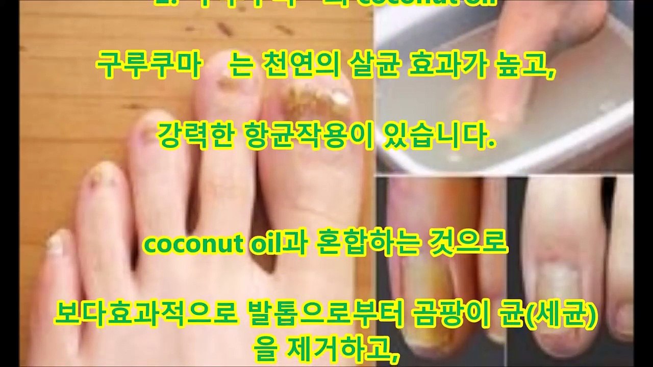 건강 발가락에 있는 곰팡이 균에 효과가 있는 간단한 개선 방법 4개