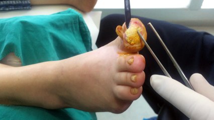 İyileşmeyen Diyabetik Ayak Yaraları