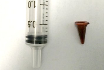 Çocukken Ciğerine Kaçan Oyuncak 40 Yıl Sonra Çıktı