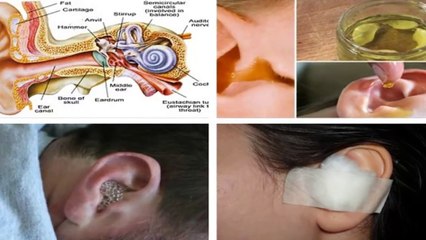 Say Goodbye To Ear Infection! Cure Ear infection In Just 1 Day 100% Naturally