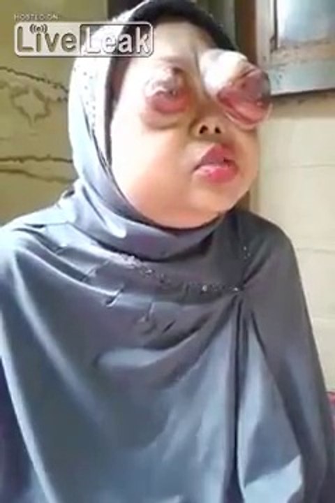 Cette femme a les yeux déformés à cause d'une maladie !