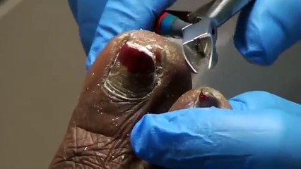 A nail trimming that was never published - thick fungal nails and calluses