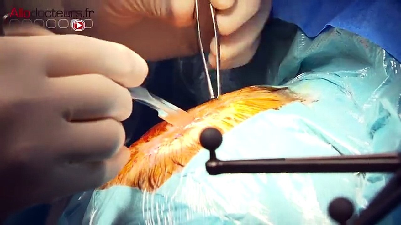 Cancer      des ultrasons pour rendre le cerveau perméable aux traitements