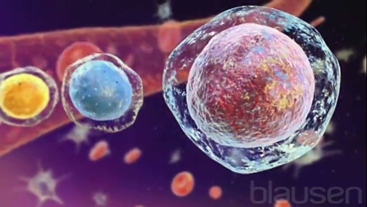 Cancer hématologique    le myélome multiple
