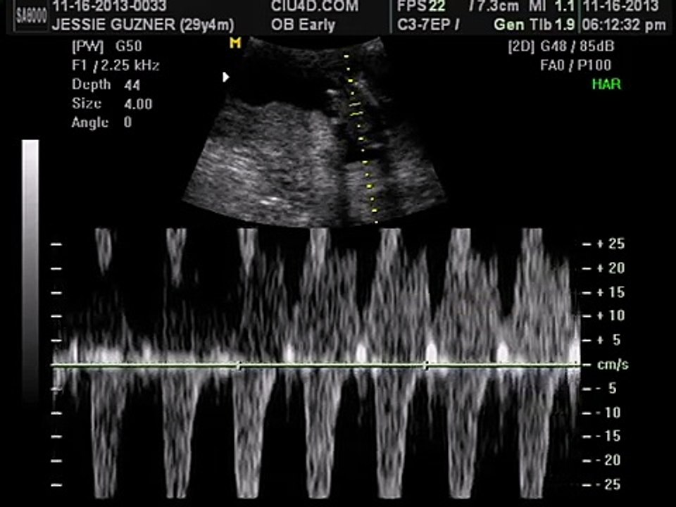 12 Weeks Pregnant Gender Determination Ultrasound - video Dailymotion