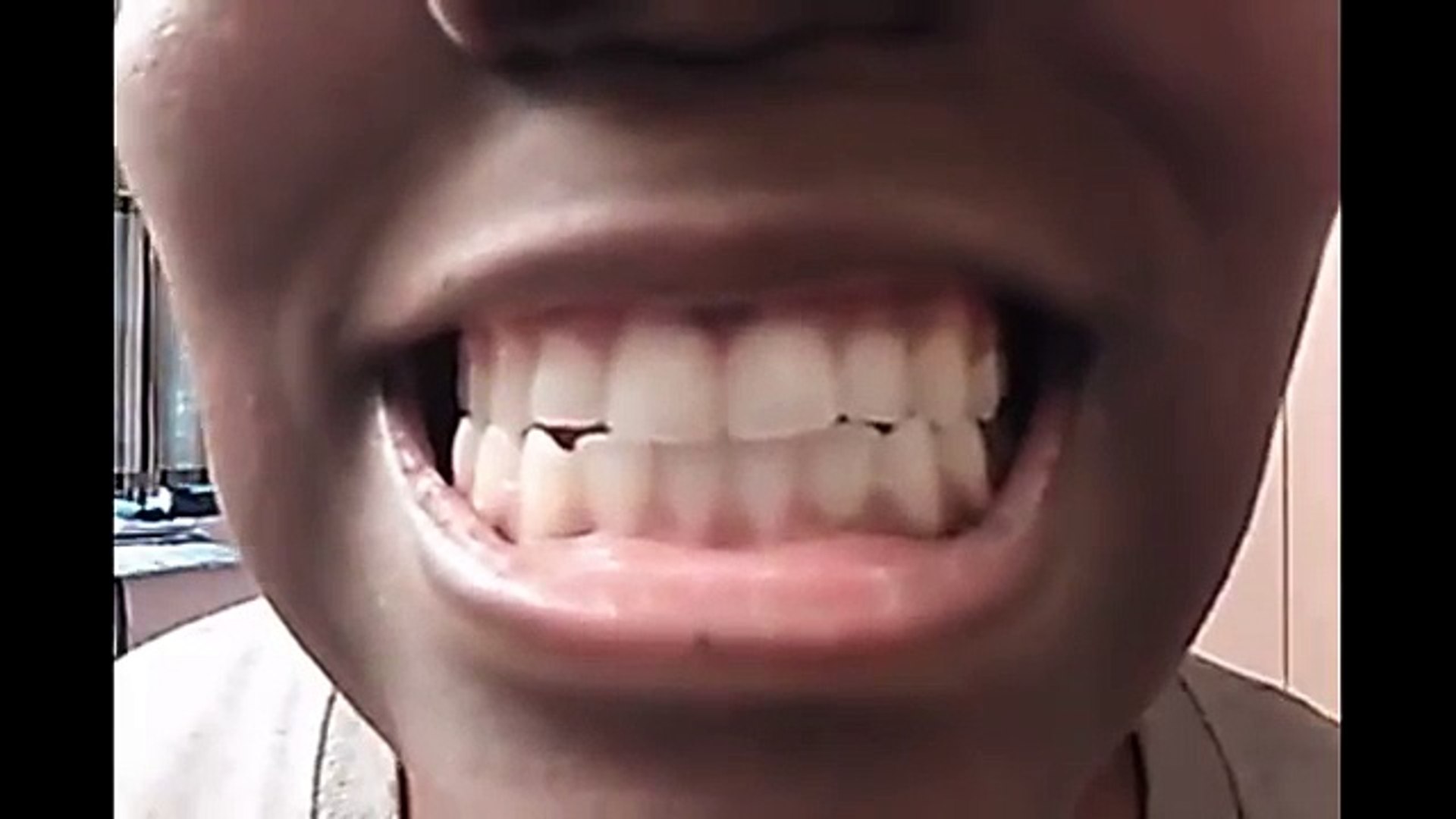 WARNING] Teeth Whitening Baking Soda and Lemon - Bad Reaction - Before &  After - The Mouth Episode - video Dailymotion