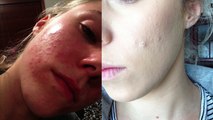 Hormonal Acne   The Pill: Curing My Hormonal Acne Naturally