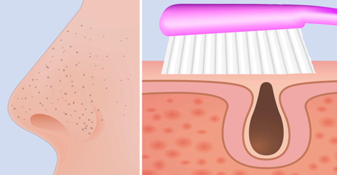 Remueve Para Siempre Los Puntos Negros Con Un Cepillo De Dientes Y 2 Ingredientes