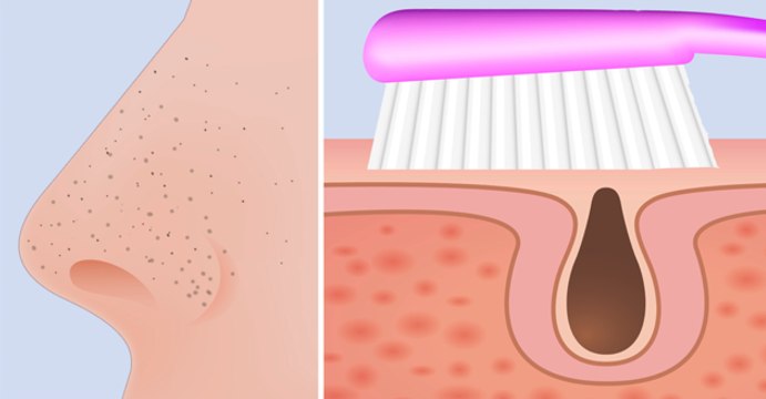Remueve Para Siempre Los Puntos Negros Con Un Cepillo De Dientes Y 2 Ingredientes