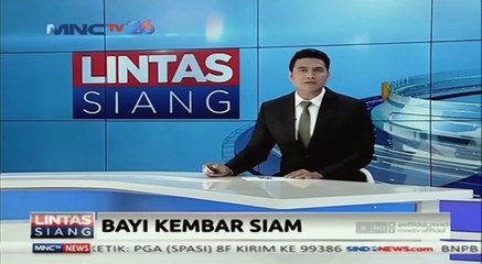 Bayi Kembar Siam Akan Jalani Operasi Pemisahan