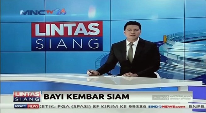 Bayi Kembar Siam Akan Jalani Operasi Pemisahan