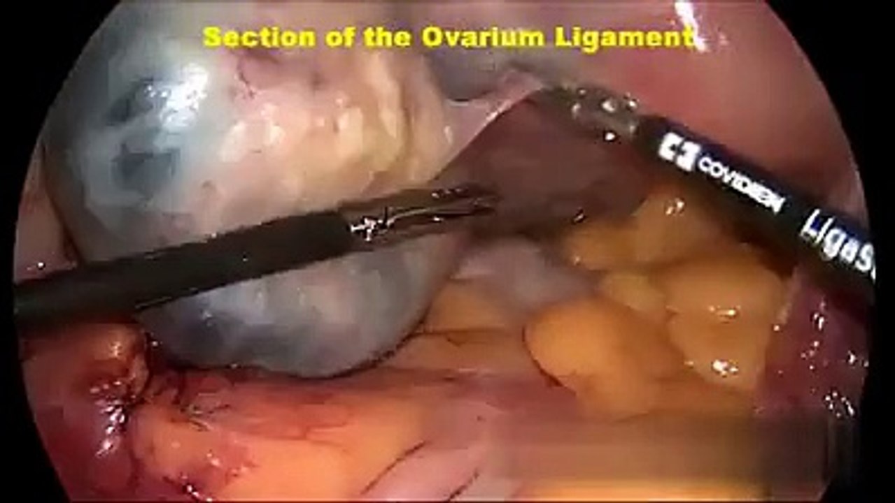 Ovarian Cancer Treatment in India At Top Hospitals In India.