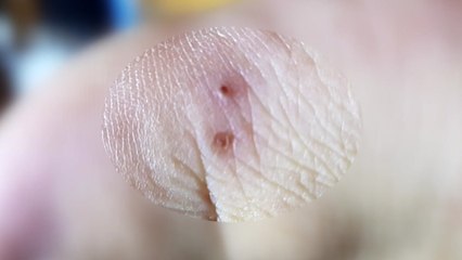 '붉은 독개미'에 물렸다면?...증상과 대처법 / YTN