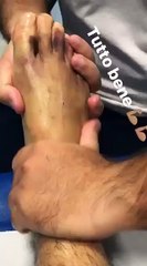 LUIS ALBERTO MASSAGGI AL PIEDE DESTRO LIVIDO