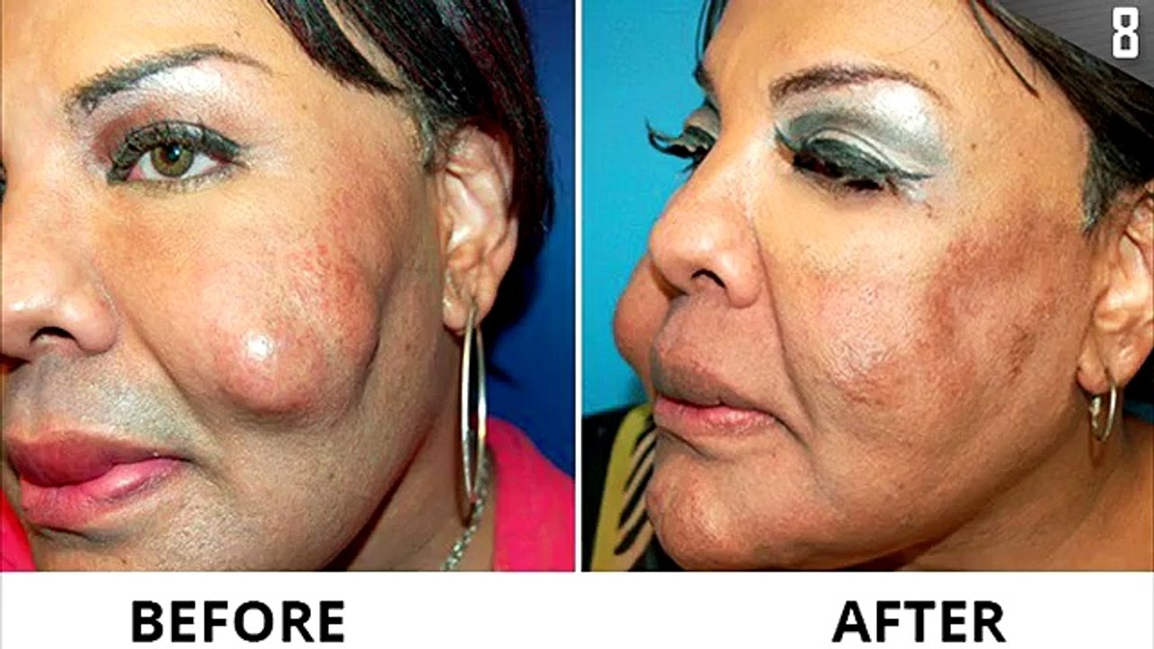10 Worst Botched Plastic Surgeries